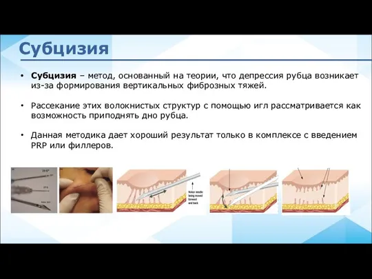 Субцизия – метод, основанный на теории, что депрессия рубца возникает из-за формирования