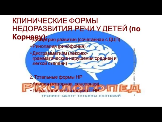 КЛИНИЧЕСКИЕ ФОРМЫ НЕДОРАЗВИТИЯ РЕЧИ У ДЕТЕЙ (по Корневу): Дизартрия развития (сочетанная с