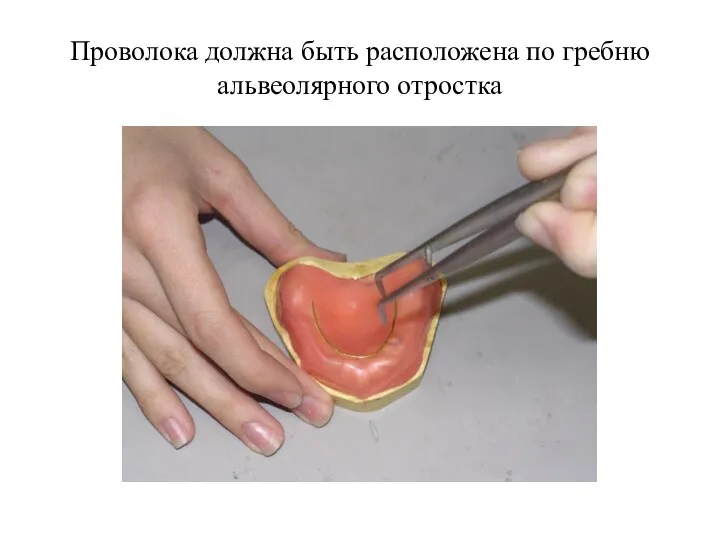 Проволока должна быть расположена по гребню альвеолярного отростка