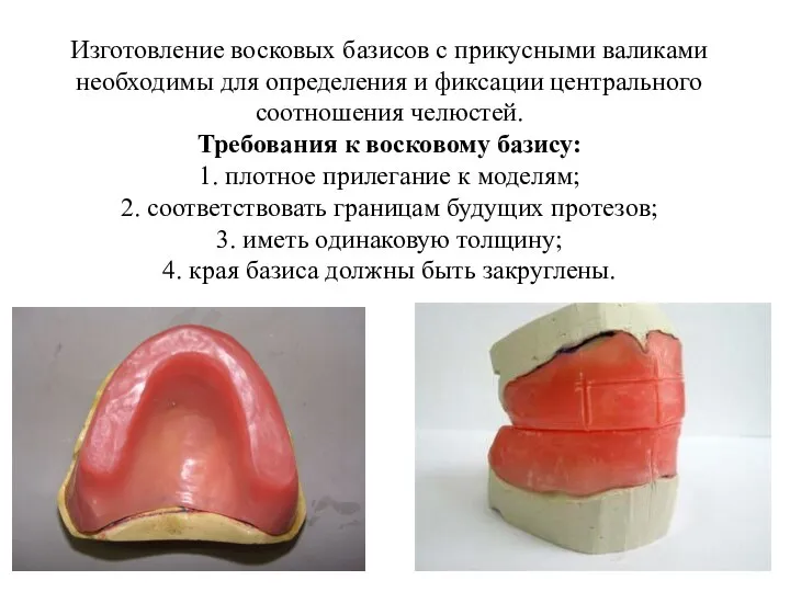 Изготовление восковых базисов с прикусными валиками необходимы для определения и фиксации центрального