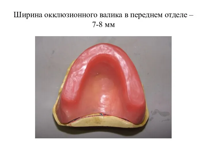 Ширина окклюзионного валика в переднем отделе – 7-8 мм