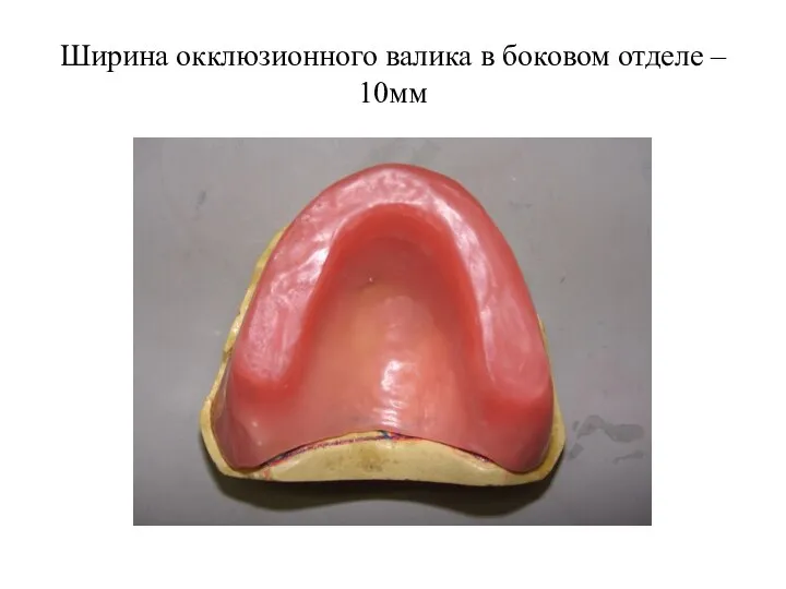 Ширина окклюзионного валика в боковом отделе – 10мм