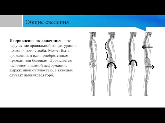 Общие сведения Искривление позвоночника – это нарушение правильной конфигурации позвоночного столба. Может