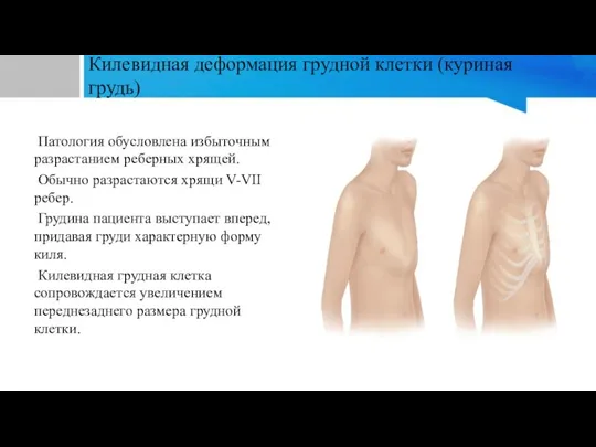 Килевидная деформация грудной клетки (куриная грудь) Патология обусловлена избыточным разрастанием реберных хрящей.