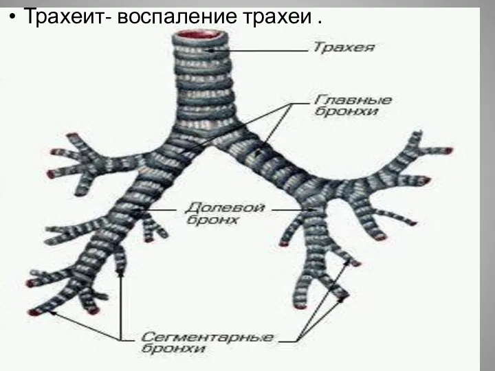 Трахеит- воспаление трахеи .