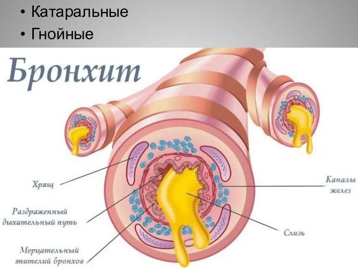 Катаральные Гнойные