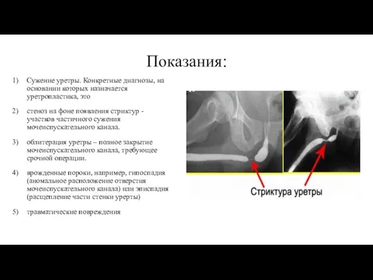 Показания: Сужение уретры. Конкретные диагнозы, на основании которых назначается уретропластика, это стеноз