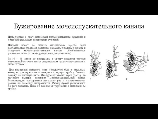 Бужирование мочеиспускательного канала Применяется с диагностической целью(выявление сужений) и лечебной целью(для расширения