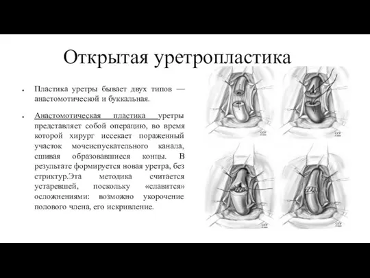 Открытая уретропластика Пластика уретры бывает двух типов — анастомотической и буккальная. Анастомотическая