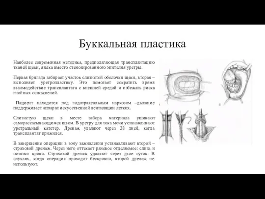 Буккальная пластика Наиболее современная методика, предполагающая трансплантацию тканей щеки, языка вместо стенозированного