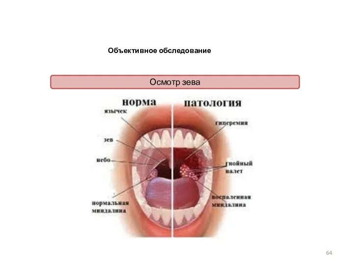 Объективное обследование Осмотр зева