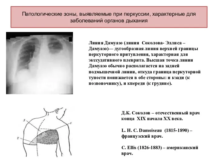 Патологические зоны, выявляемые при перкуссии, характерные для заболеваний органов дыхания Линия Дамуазо