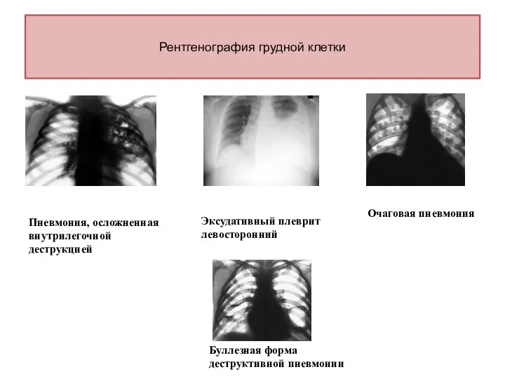 Рентгенография грудной клетки Пневмония, осложненная внутрилегочной деструкцией Эксудативный плеврит левосторонний Очаговая пневмония Буллезная форма деструктивной пневмонии