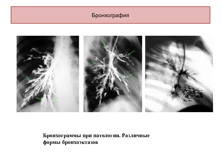 Бронхография Бронхограммы при патологии. Различные формы бронхоэктазов