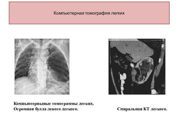 Компьютерная томография легких Компъютерныные томограммы легких. Огромная булла левого легкого. Спиральная КТ легкого.