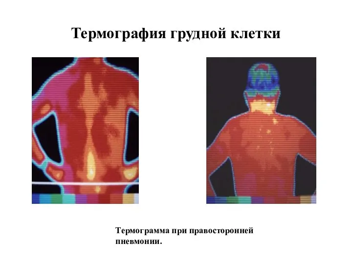 Термография грудной клетки Термограмма при правосторонней пневмонии.