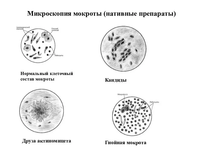 Кандиды Друза актиномицета Гнойная мокрота Нормальный клеточный состав мокроты Микроскопия мокроты (нативные препараты)