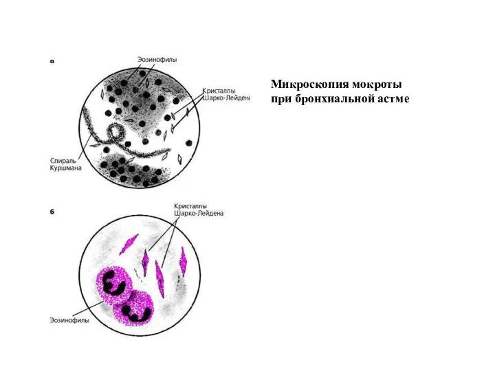 Микроскопия мокроты при бронхиальной астме