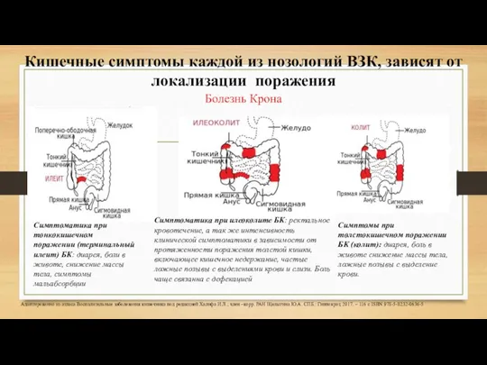 Кишечные симптомы каждой из нозологий ВЗК, зависят от локализации поражения Болезнь Крона