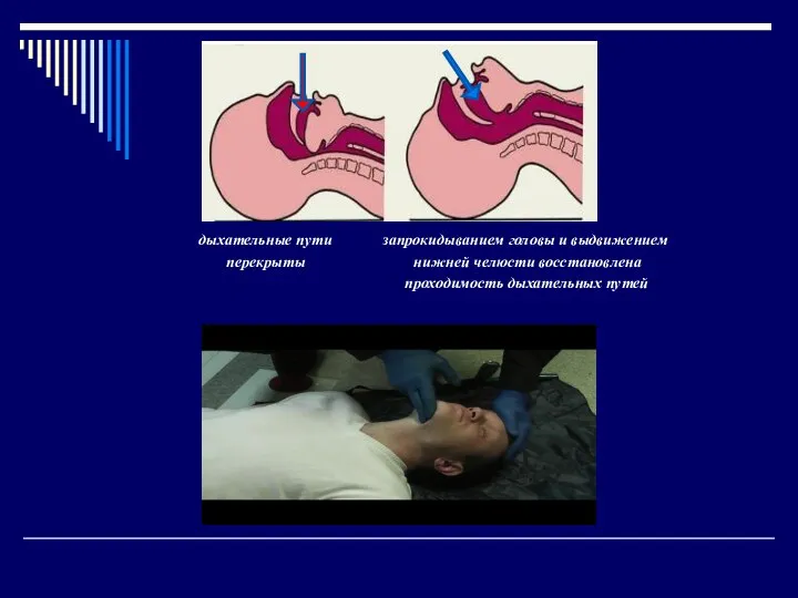 дыхательные пути запрокидыванием головы и выдвижением перекрыты нижней челюсти восстановлена проходимость дыхательных путей