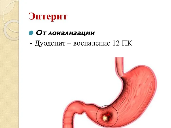 Энтерит От локализации - Дуоденит – воспаление 12 ПК