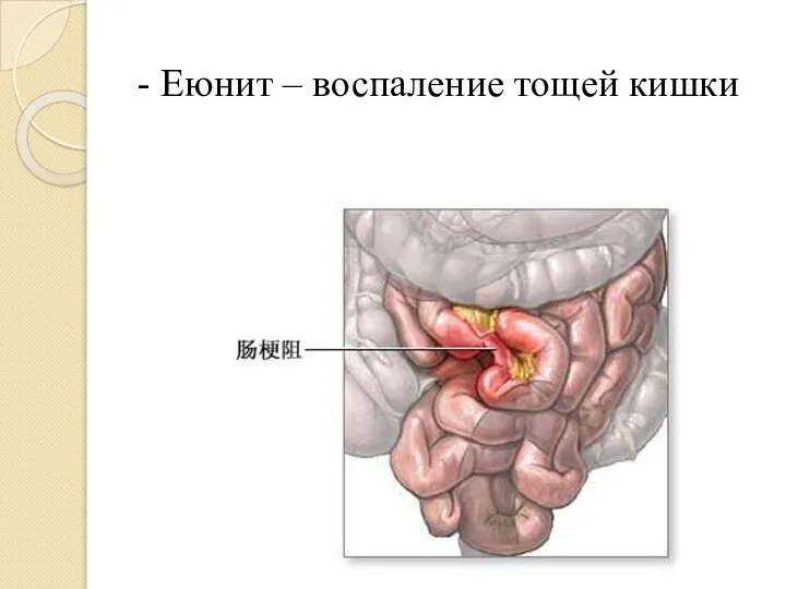 - Еюнит – воспаление тощей кишки