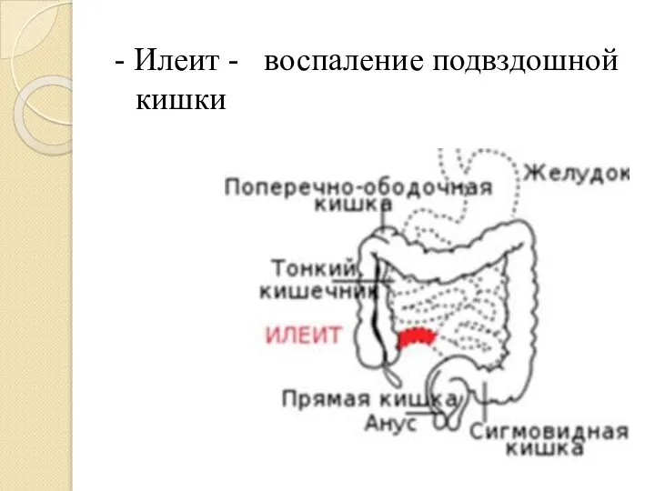 - Илеит - воспаление подвздошной кишки