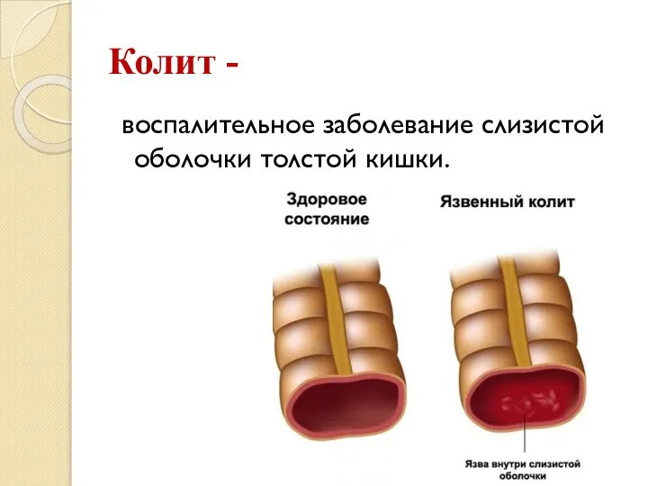 Колит - воспалительное заболевание слизистой оболочки толстой кишки.