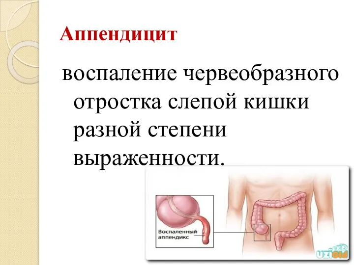 Аппендицит воспаление червеобразного отростка слепой кишки разной степени выраженности.