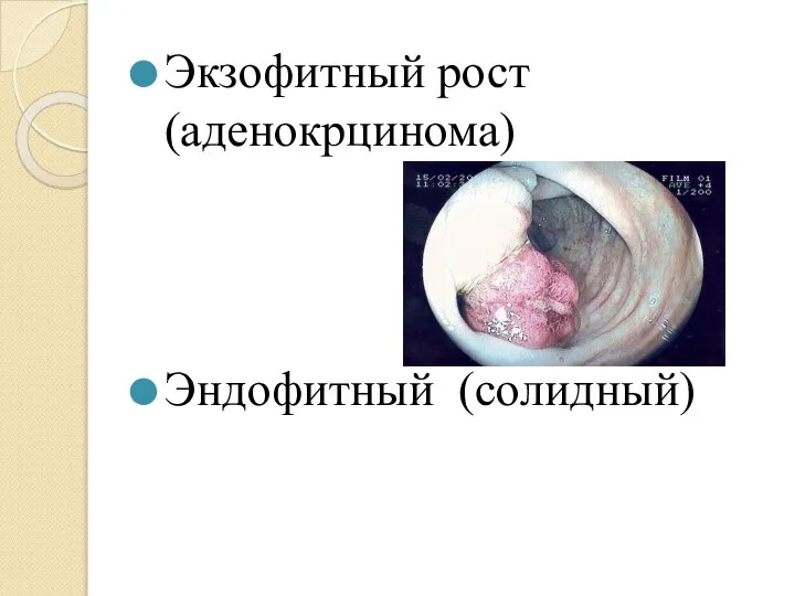 Экзофитный рост (аденокрцинома) Эндофитный (солидный)