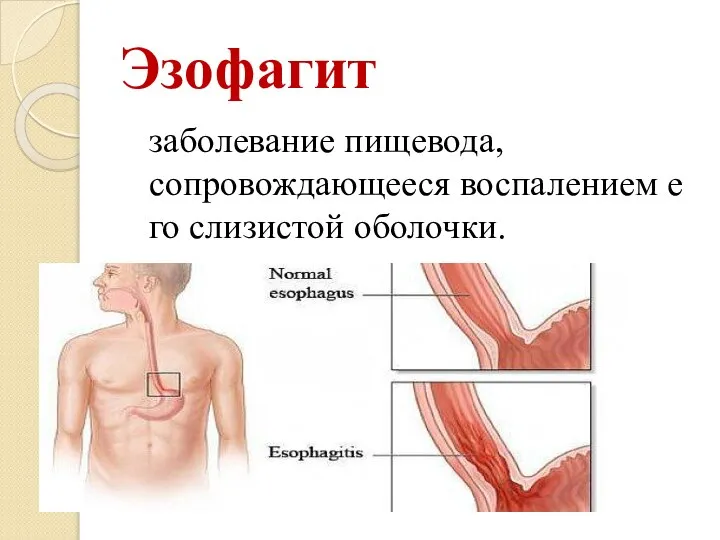 Эзофагит заболевание пищевода, сопровождающееся воспалением его слизистой оболочки.