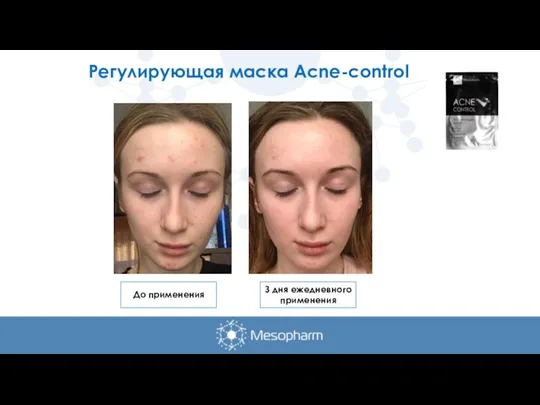 Регулирующая маска Acne-control До применения З дня ежедневного применения