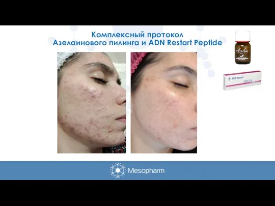 Комплексный протокол Азелаинового пилинга и ADN Restart Peptide