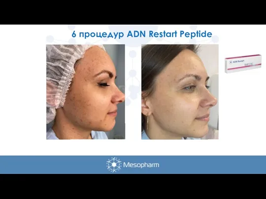 6 процедур ADN Restart Peptide