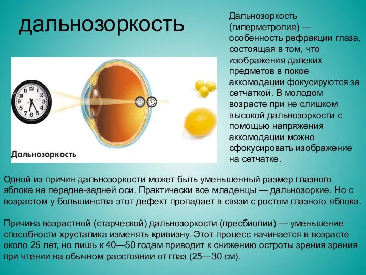 дальнозоркость Дальнозоркость (гиперметропия) — особенность рефракции глаза, состоящая в том, что изображения