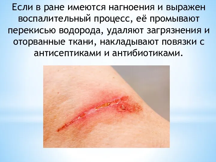 Если в ране имеются нагноения и выражен воспалительный процесс, её промывают перекисью