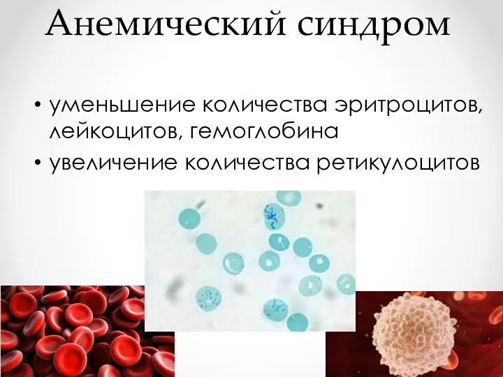 Анемический синдром уменьшение количества эритроцитов, лейкоцитов, гемоглобина увеличение количества ретикулоцитов