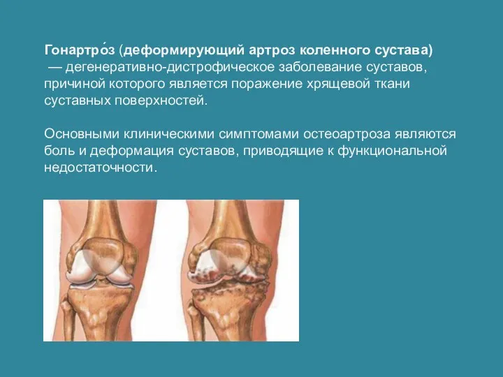 Гонартро́з (деформирующий артроз коленного сустава) — дегенеративно-дистрофическое заболевание суставов, причиной которого является