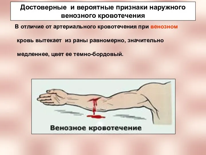 Достоверные и вероятные признаки наружного венозного кровотечения В отличие от артериального кровотечения