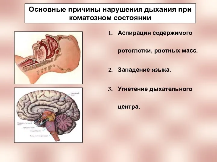 Основные причины нарушения дыхания при коматозном состоянии Аспирация содержимого ротоглотки, рвотных масс.