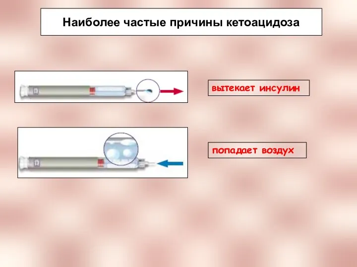 Наиболее частые причины кетоацидоза вытекает инсулин попадает воздух