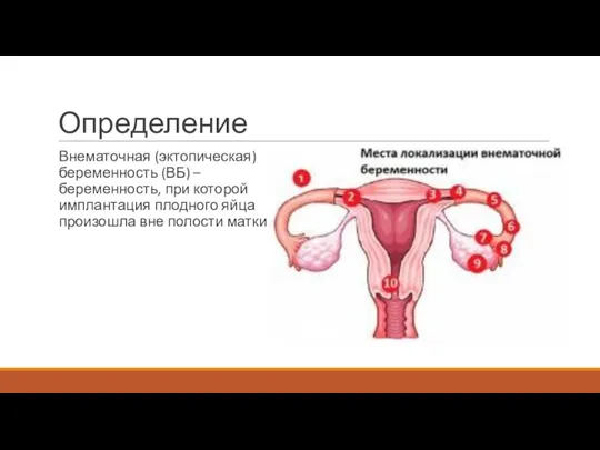 Определение Внематочная (эктопическая) беременность (ВБ) – беременность, при которой имплантация плодного яйца произошла вне полости матки