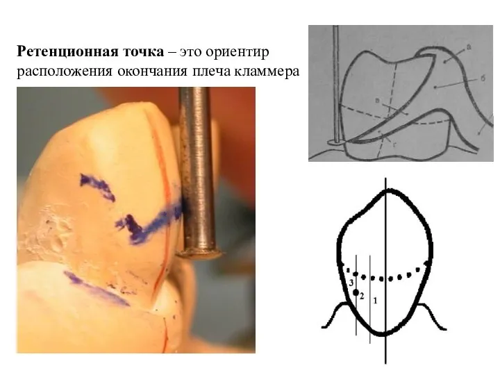 Ретенционная точка – это ориентир расположения окончания плеча кламмера