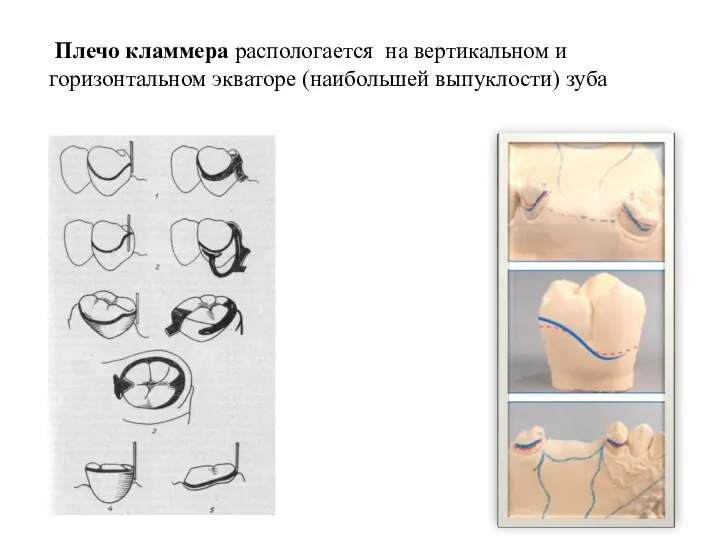 Плечо кламмера распологается на вертикальном и горизонтальном экваторе (наибольшей выпуклости) зуба