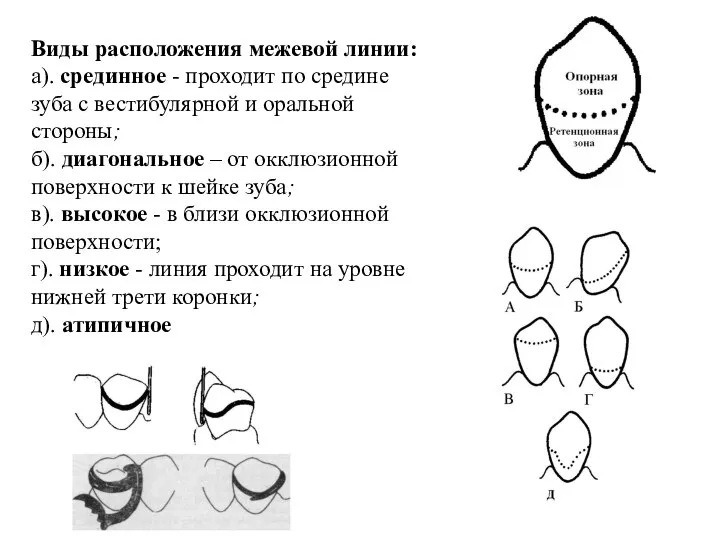 Виды расположения межевой линии: а). срединное - проходит по средине зуба с