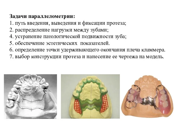 Задачи параллелометрии: 1. путь введения, выведения и фиксации протеза; 2. распределение нагрузки