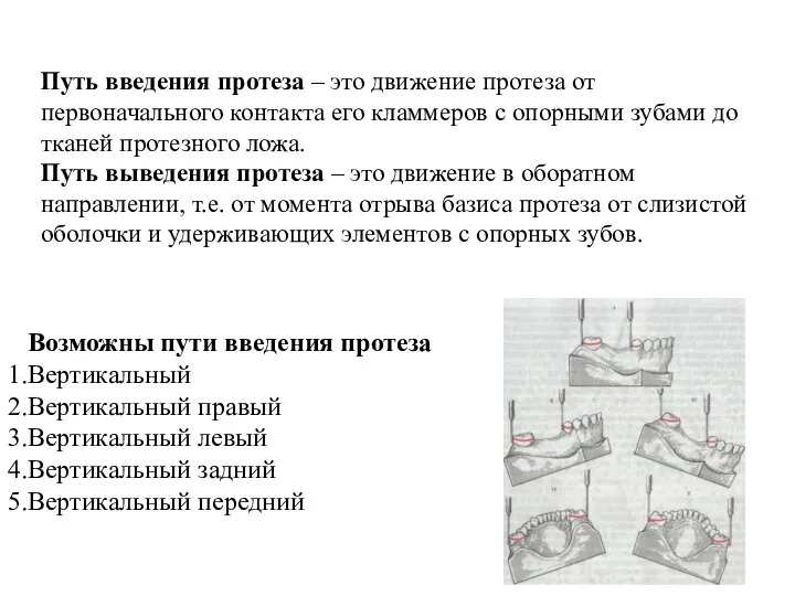 Путь введения протеза – это движение протеза от первоначального контакта его кламмеров