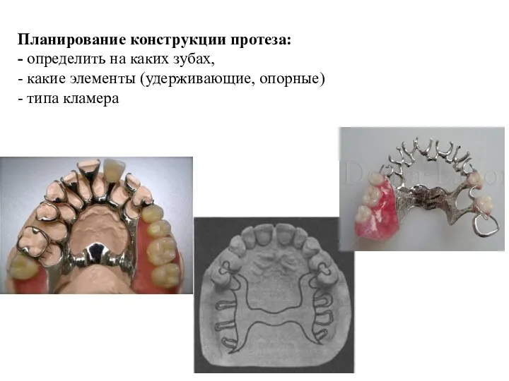 Планирование конструкции протеза: - определить на каких зубах, - какие элементы (удерживающие, опорные) - типа кламера