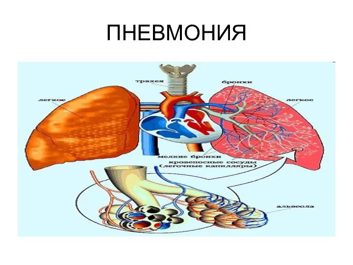 ПНЕВМОНИЯ