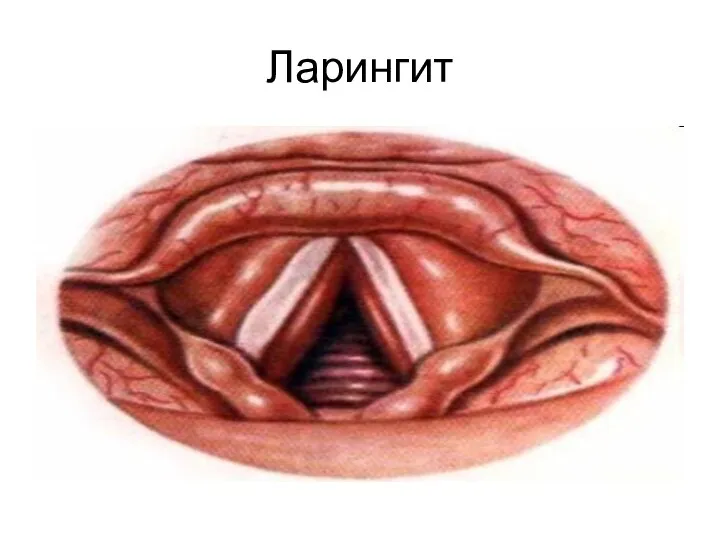 Ларингит